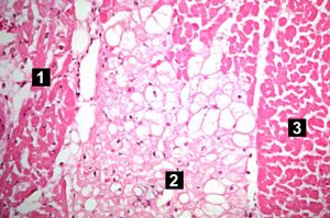 IPLab1MyocardialInfarction7.jpg