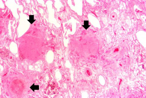 IPLab1Tuberculosis5.jpg