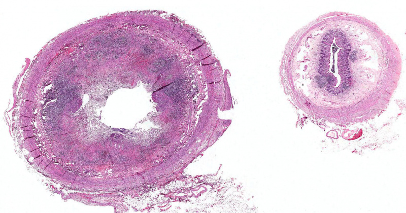 File:IPLab3AcuteAppendicitis2b.jpg