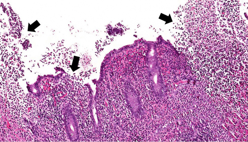 File:IPLab3AcuteAppendicitis5b.jpg