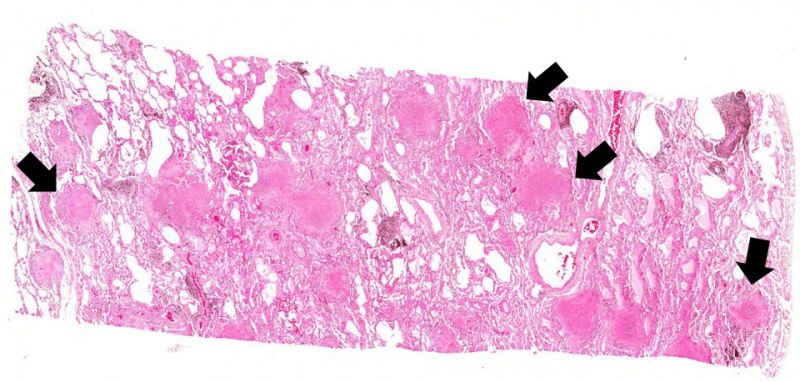 File:IPLab1Tuberculosis4b.jpg