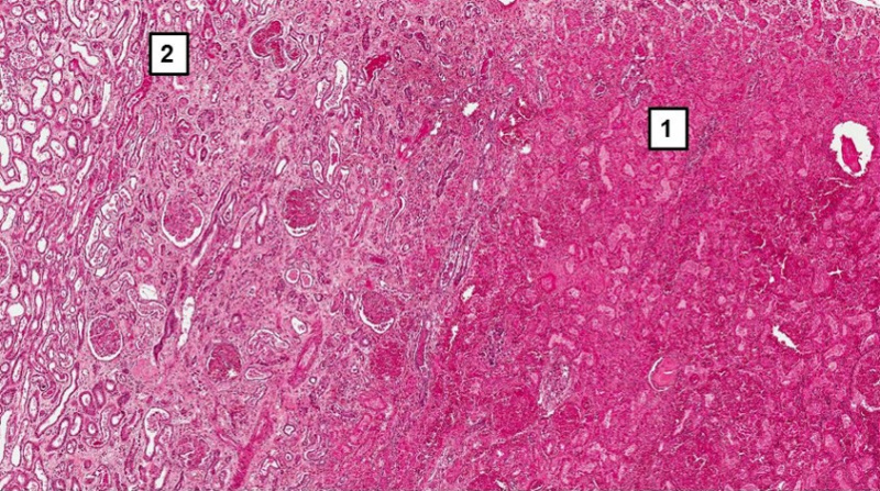 File:IPLab1KidneyInfarction4.jpg
