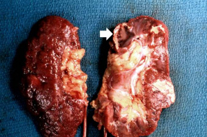 IPLab1KidneyInfarction1.jpg