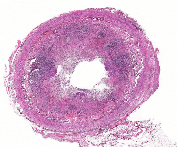 File:IPLab3AcuteAppendicitis2x.jpg