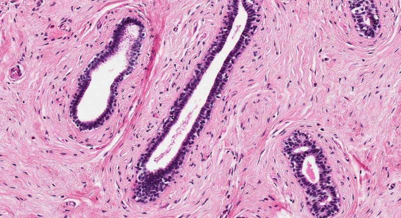 File:IPLab7Fibroadenoma4b.jpg