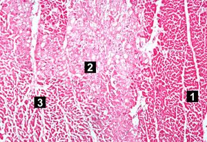 IPLab1MyocardialInfarction4.jpg