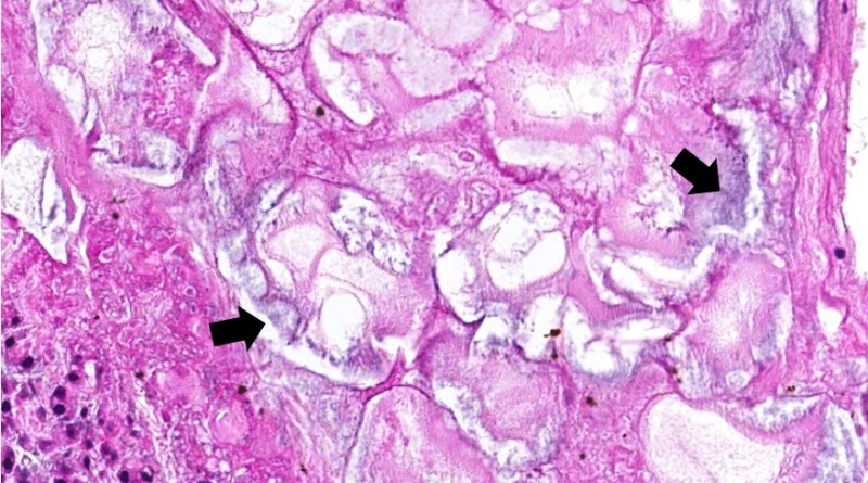 File:IPLab1FatNecrosis8.jpg