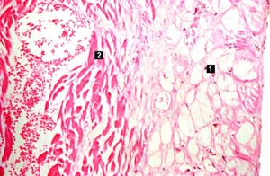 IPLab1MyocardialInfarction6.jpg