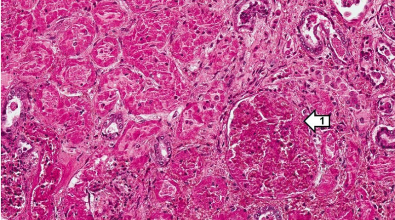 File:IPLab1KidneyInfarction5.jpg