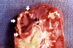 IPLab1KidneyInfarction2.jpg