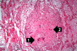 IPLab1Tuberculosis7.jpg