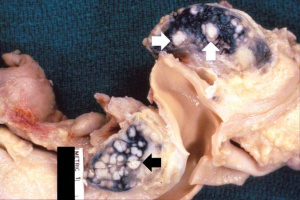 IPLab1Tuberculosis3.jpg