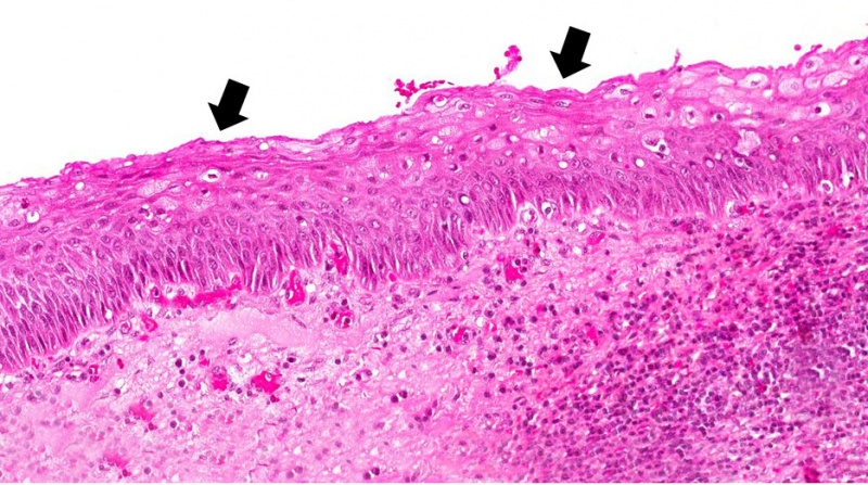 File:IPLab2Metaplasia5b.jpg
