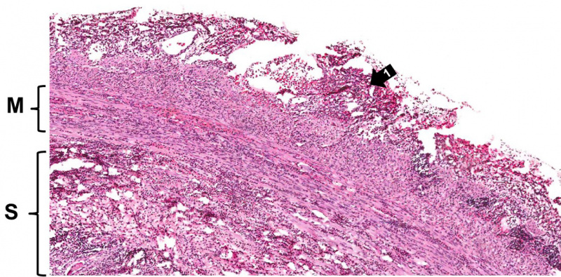 File:IPLab3AcuteAppendicitis3b.jpg