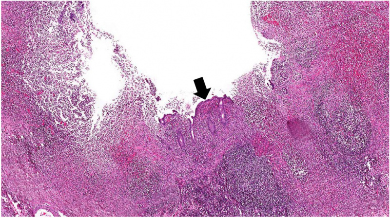 File:IPLab3AcuteAppendicitis4b.jpg