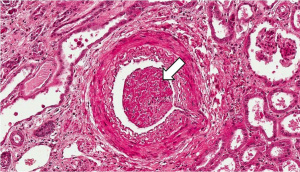 IPLab1KidneyInfarction6.jpg